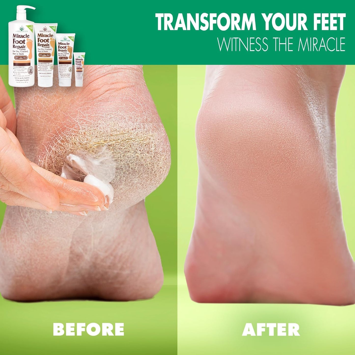 Miracle Foot Repair Cream, (1 oz / 3 Pack) Repairs Dry Cracked Heels and Feet, 60% Pure UltraAloe Moisturizes, Softens, and Repairs